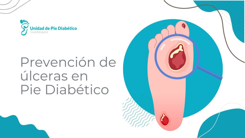 Prevención de úlceras en pie diabético: cómo cuidar tus pies cada día