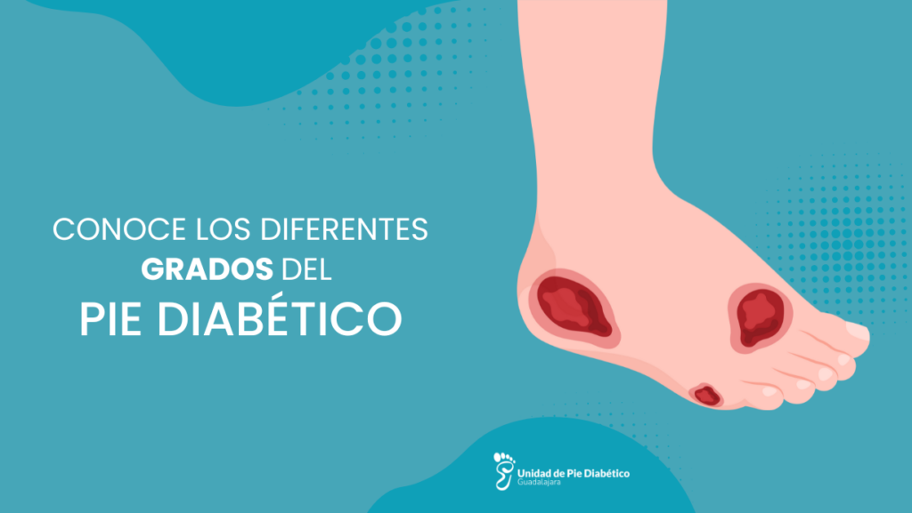 grados del pie diabético