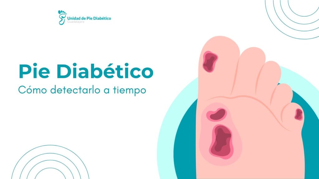 como detectar el pie diabetico a tiempo